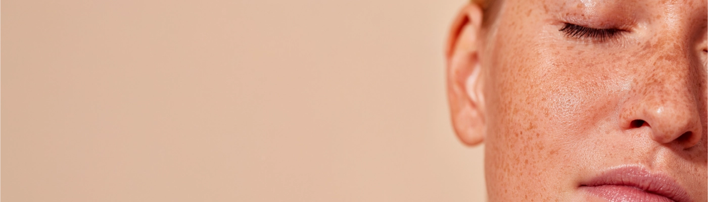 Cómo eliminar las manchas por el sol