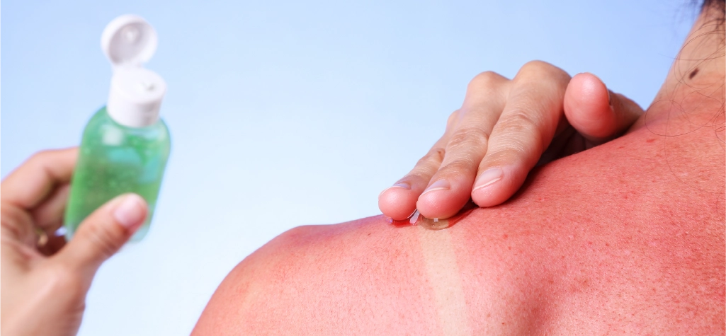 Cómo evitar quemaduras solares