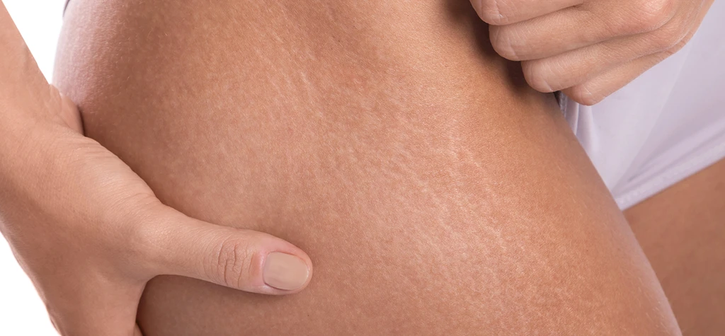 Diferentes tipos de estrías